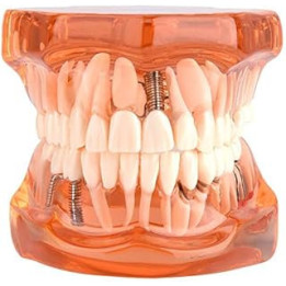 Teeth Model - Removable Dental Teeth Implant Model Dentist Demonstration Tool for Dental School Study Teaching, Orange